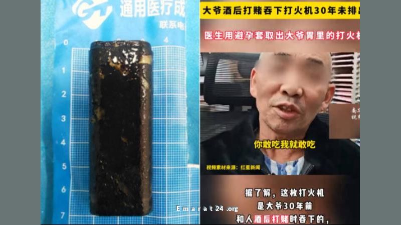 اكتشاف ولاعة تعمل في معدة رجل منذ 40 عامًا