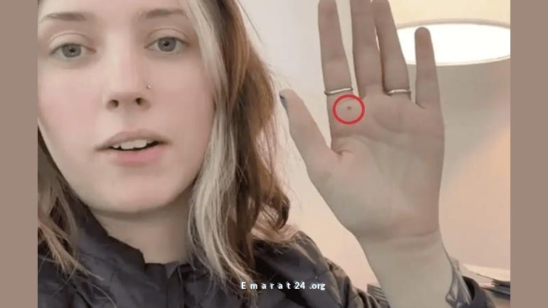 تشات جي بي تي يساعد امرأة في كشف سرطان جلد نادر من خلال تحليل كفها