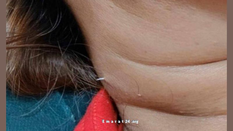 امرأة تكتشف حسكة سمكة تخرج من رقبتها بعد تجاهل الأطباء امرأة تكتشف حسكة سمكة تخرج من رقبتها بعد تجاهل الأطباء
