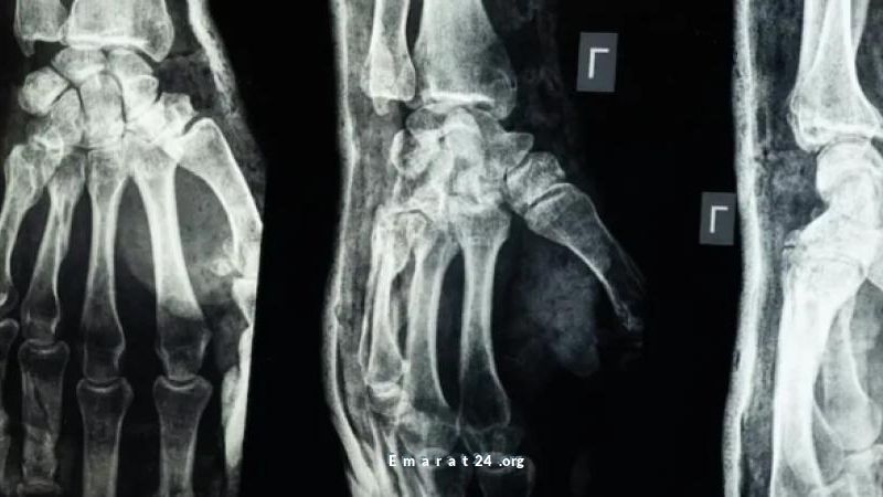 غراء طبي خارق يلتئم العظام المكسورة في دقائق معدودة فقط