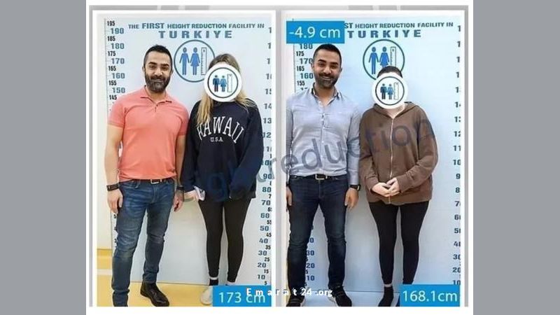 مستشفيات توفر حلول تقصير القامة للنساء المزعجات من طولهن مستشفيات توفر حلول تقصير القامة للنساء المزعجات من طولهن