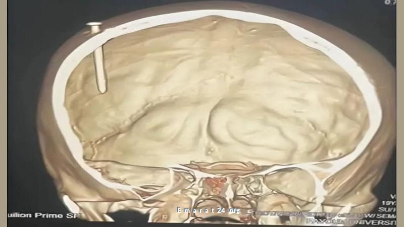 ٥ ساعات في العمليات لإنقاذ طفل مصري من مسمار في الرأس ٥ ساعات في العمليات لإنقاذ طفل مصري من مسمار في الرأس